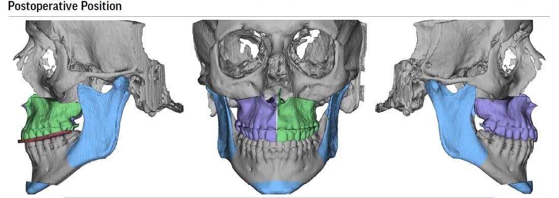 Jaw Surgery West Harrison NY | Corrective Jaw Surgery White Plains, Rye